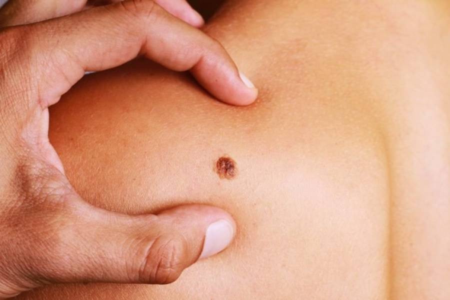 Un tratamiento de inmunoterapia permite sobrevivir a 52 % de pacientes con cáncer de piel