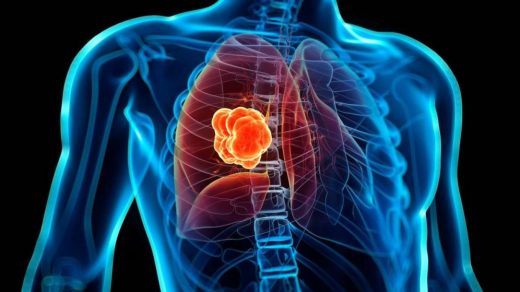 Descubren tratamiento que reduce el cáncer de pulmón y evita recaídas