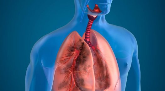 Enfermedades respiratorias crónicas generaron más muertes en los últimos 30 años