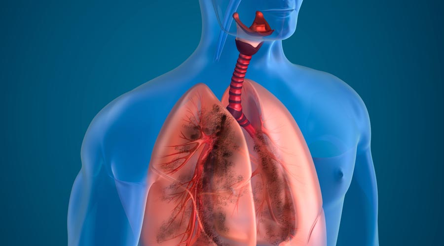 Enfermedades respiratorias crónicas generaron más muertes en los últimos 30 años