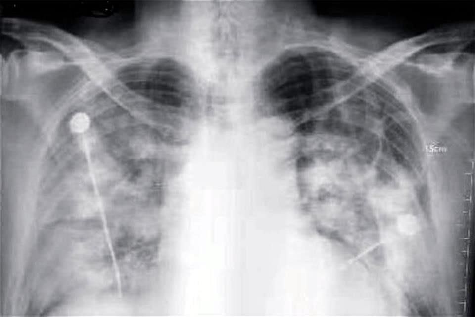 pulmonar.jpg