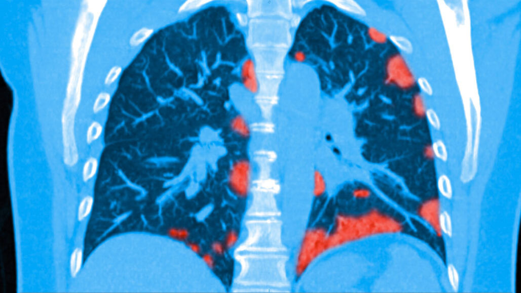 Hallan la segunda ‘llave’ que usa el covid-19 para penetrar en los pulmones