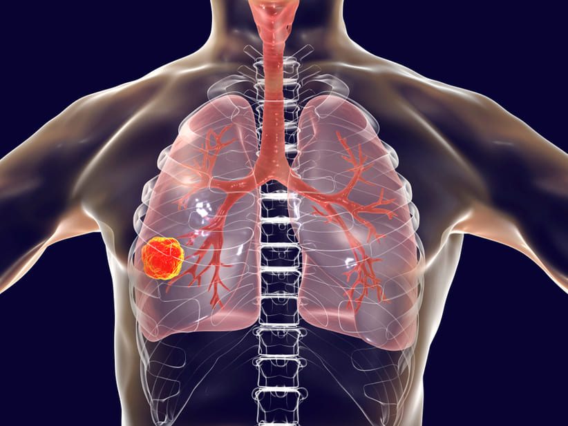 Describen el grave impacto que tendrá la cuarentena en cifras de tuberculosis