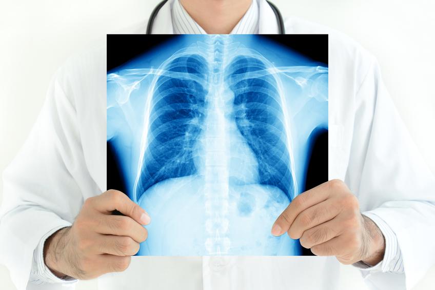 Revelan quiénes con COVID-19 tienen mayor riesgo de sufrir perforación de pulmón