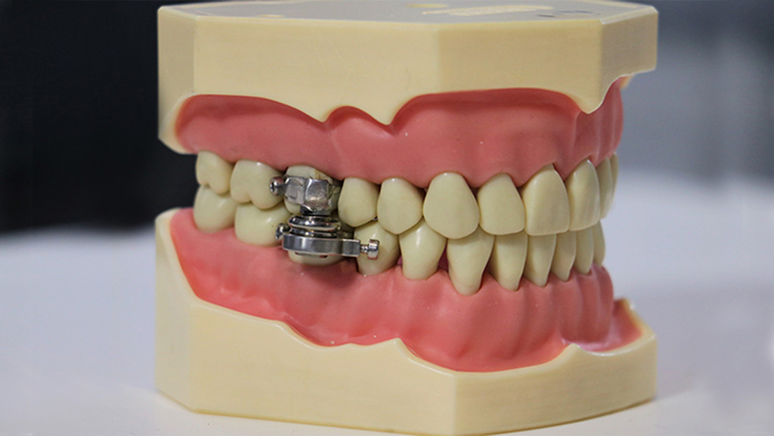 «Candado de dientes»: crean un dispositivo para perder peso que impide abrir la boca