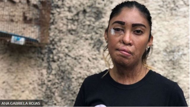 La historia de Esmeralda Millán, víctima de los ataques con ácido en México: «Me decía que si yo no era suya, no iba a ser de nadie. Lo dejé y me atacó»