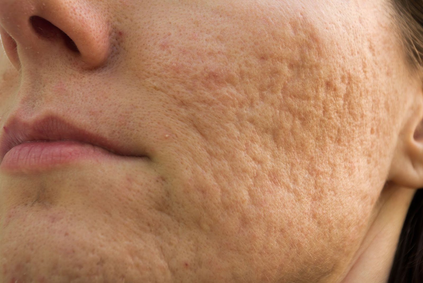 ¿Es posible eliminar las cicatrices del acné?