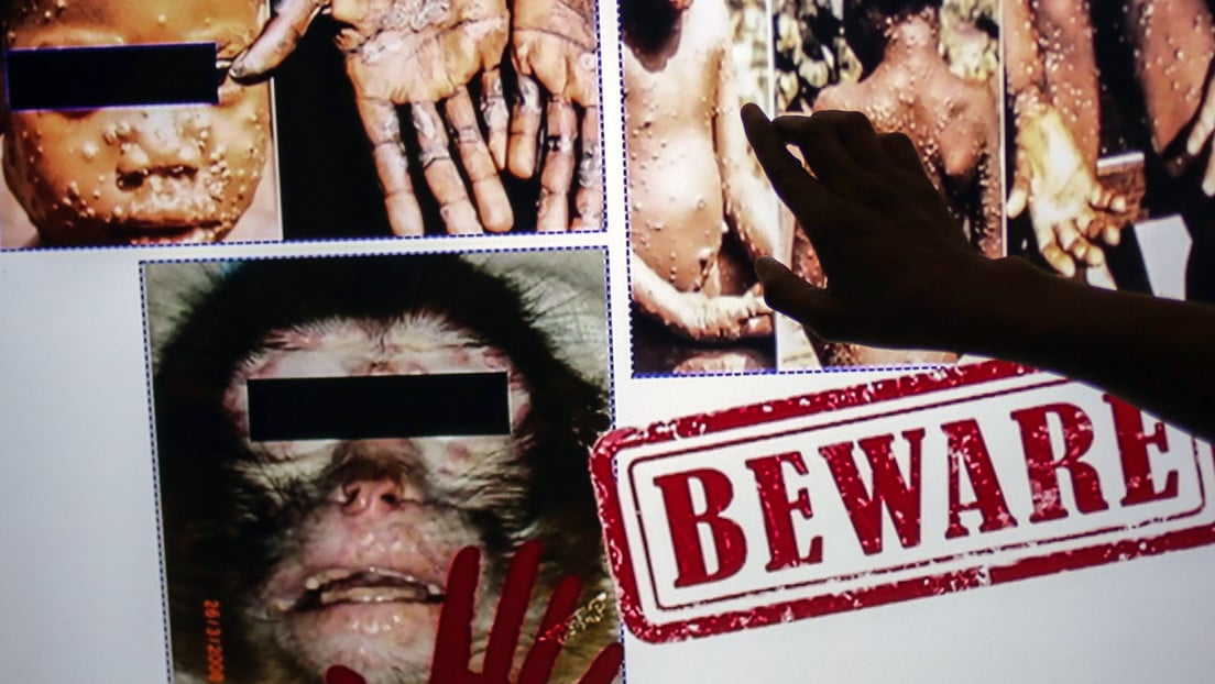 La viruela del mono se expande: ¿Qué se sabe de la enfermedad, dónde está y cuán peligrosa es?