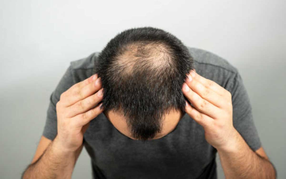 Alopecia-tratamiento