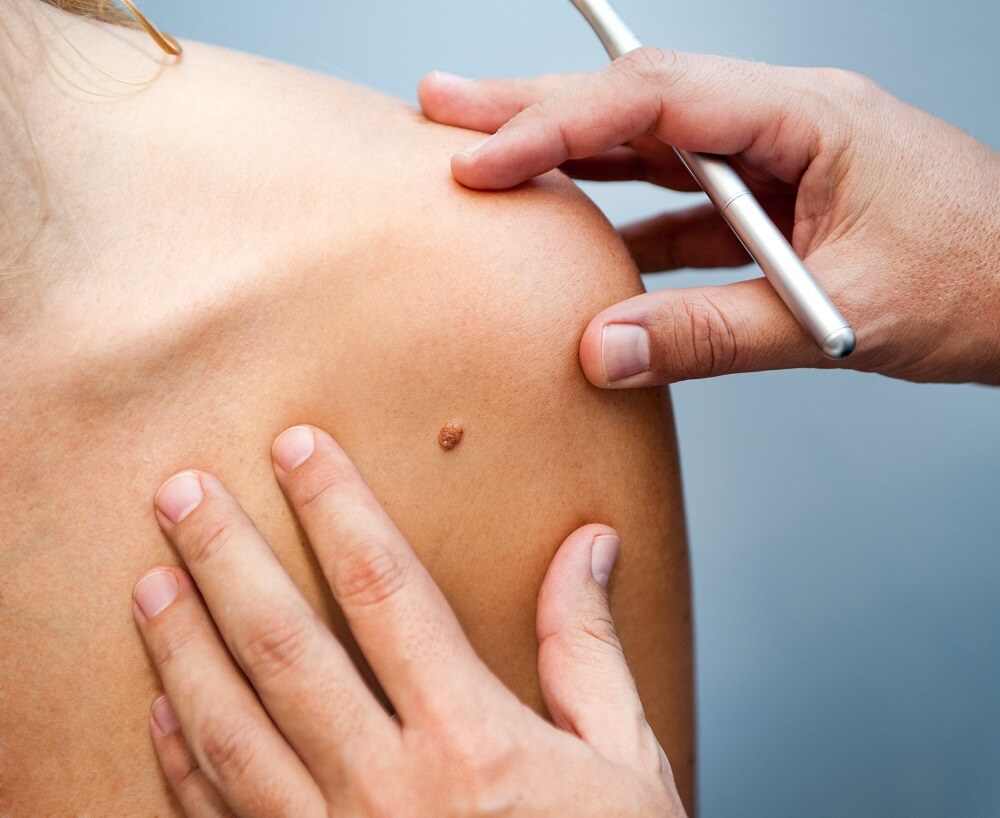 Aumento de cáncer de piel amenaza ante olas de calor