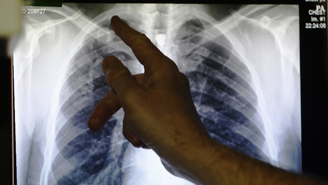 Por primera vez en muchos años: OMS registra un aumento de los casos de tuberculosis resistente a fármacos