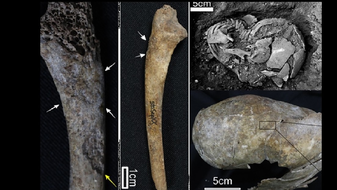 Descubren la evidencia más antigua de sífilis en América