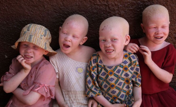 Personas con albinismo víctimas de una ola de secuestros y asesinatos en Madagascar