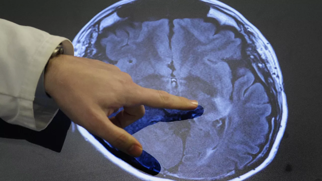 Investigadores chilenos predicen el riesgo del Alzheimer usando inteligencia artificial