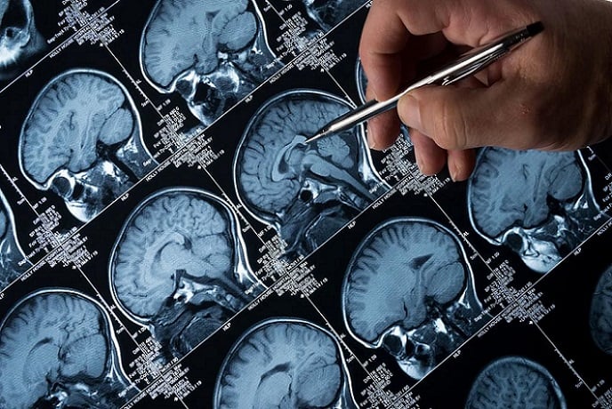 Científicos chilenos lideran importante investigación internacional en la lucha contra el Alzheimer