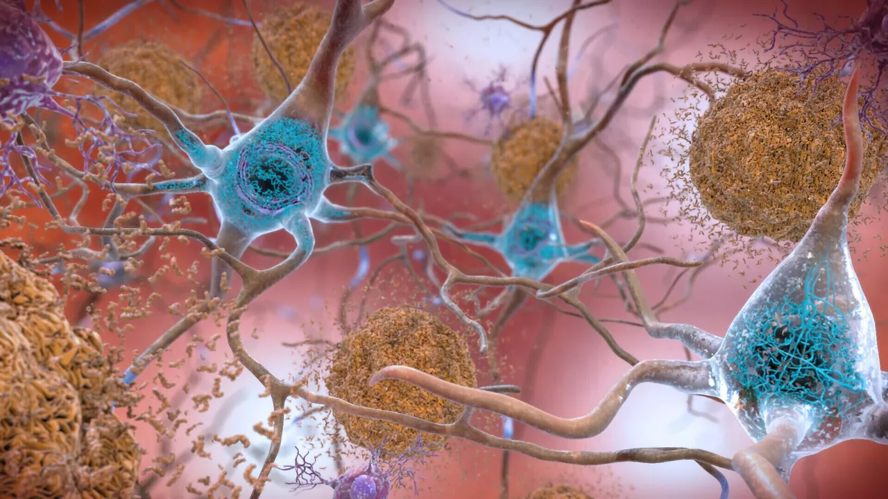Nuevo fármaco puede ralentizar progresión del Alzheimer
