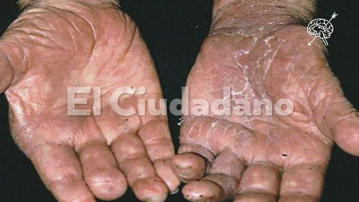 Revela Secretaría de Salud 14 casos de lepra en Puebla