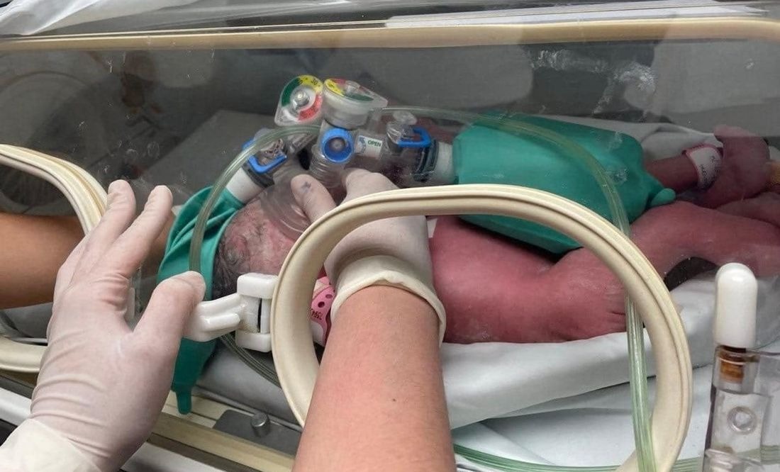 En Monterrey Nuevo León,  nacen bebés siamesas