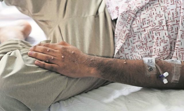 OMS advierte sobre brote de mpox con variantes en África
