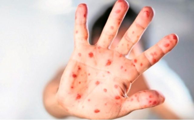 México confirma más de 4 mil casos de mpox antes viruela del mono