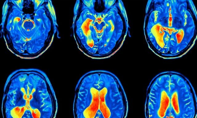 La pandemia aceleró el desarrollo cerebral en adolescentes, afectando más a las chicas